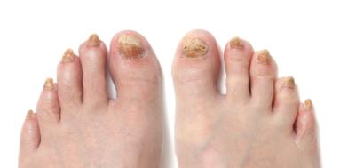 Ingrown nail - Wikipedia