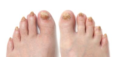 cure nail fungus cure nail fungus