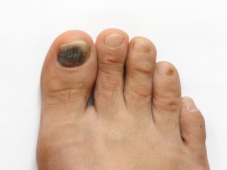 Bruised or black toenail Bruised or black toenail