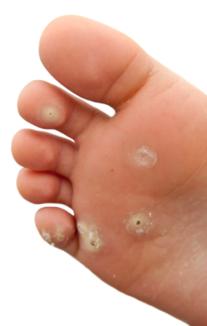 Verruca or Plantar wart