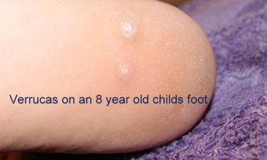 Verrucas on childs foot