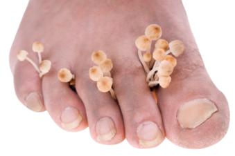 Click to take you to Athletes Foot Treatment Foot fungus